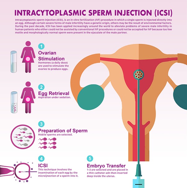 What Is Icsi Intracytoplasmic Sperm Injection Dr Roshi Satija